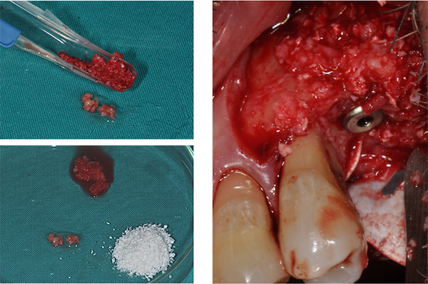 Osso autologo miscelato a biomateriale Bioss e posizionamento miscela ossea in sede periimplantare