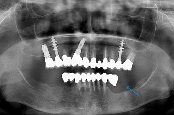 OPT pre-intervento, si noti perdita d’osso arcata mandibolare