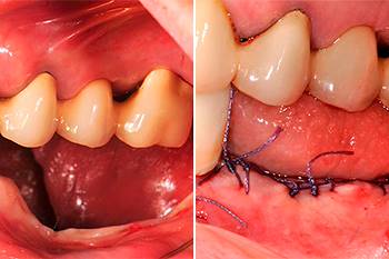 Rigenerativa ossea verticale mandibolare