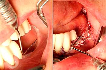 Rigenerativa ossea verticale mandibolare con inserimento 3 impianti