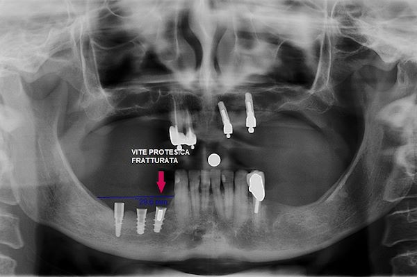 OPT INIZIALE 23.11.2012 Impianti inutilizzabili per la frattura della vite protesica