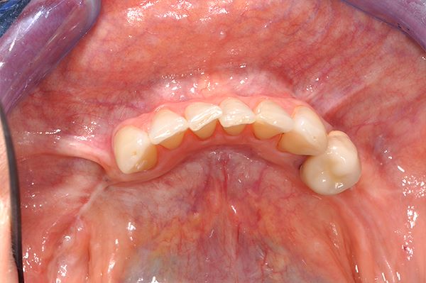 Visione occlusale: guarigione avvenuta dopo 3 mesi dalla rimozione degli impianti