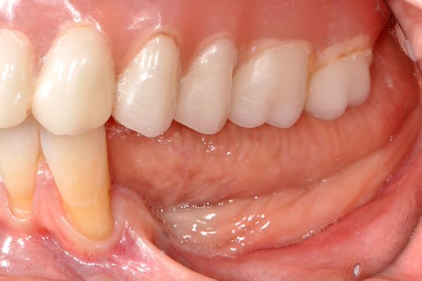 Visione laterale: guarigione avvenuta dopo 3 mesi dalla rimozione degli impianti; si noti la severa atrofia ossea verticale (mancanza d’osso)