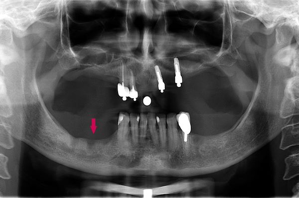 OPT 08.03.2013 Si noti l’importante atrofia ossea verticale mandibolare (l’osso si presenta a forma di mezzaluna)