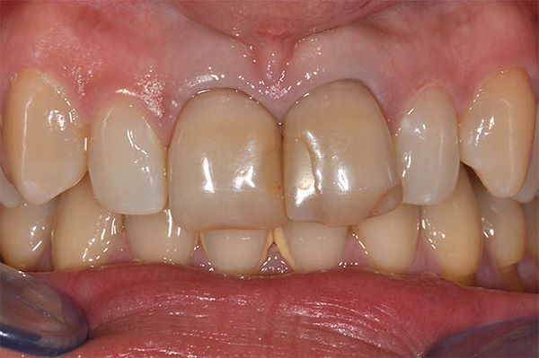 Dopo sbiancamento interno e rifacimento delle ricostruzioni in composito