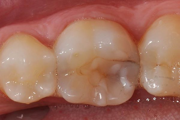 Presenza di vecchio intarsio infiltrato con carie secondaria