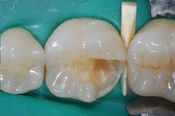 Rimozione del vecchio restauro e del tessuto cariato