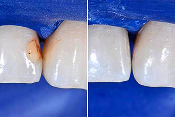 Sostituzione otturazione in composito pigmentata