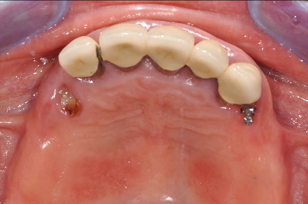 Visione occlusale -  Dopo un attento studio del caso clinico si decide di estrarre tutti gli elementi dentari dell’arcata superiore