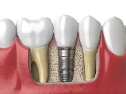 impianti-dentali-Bergamo-Daina
