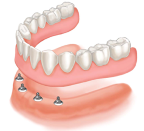 protesi-totale-ritenzione-implantare