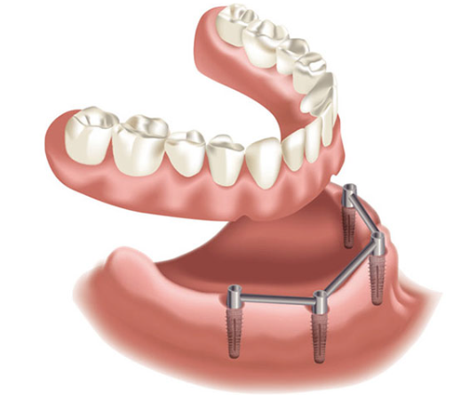 protesi-totale-a-appoggio-implantare