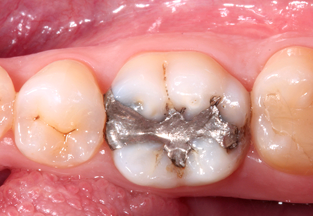 Penna Riscaldata Dentale AZDENT Penna Riscaldata AZDENT Con 2 Punte Intercambiabili, Per Laboratorio Odontotecnico E Uso Endodontico Penna Per Foil