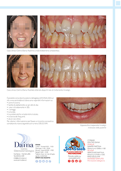 Mostra il tuo sorriso con Invisalign al Centro Daina _ QuiBg n. 246 Ottobre 2017 Mostra il tuo sorriso con Invisalign al Centro Daina _ QuiBg n. 246 Ottobre 2017