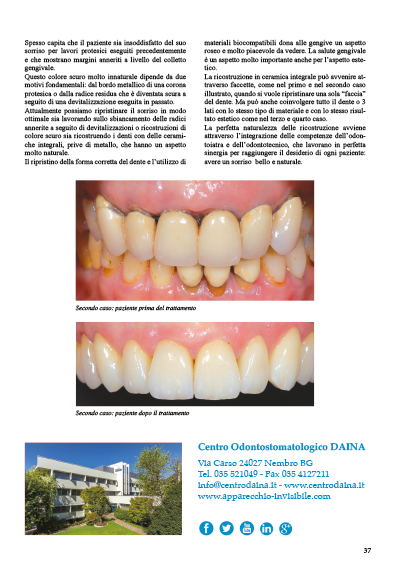 La ricostruzione del sorriso _ n. 65 Maggio 2016 La ricostruzione del sorriso _ n. 65 Maggio 2016